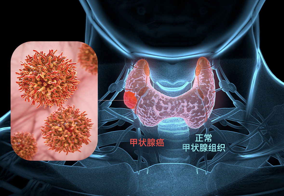 6甲状腺癌.png
